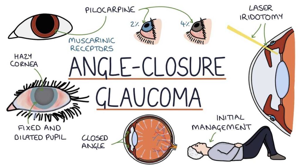 Angle Closure Glaucoma