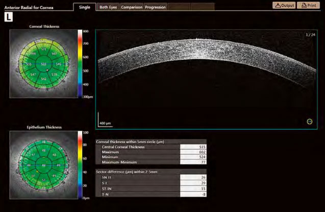 ANTERIOR SEGMENT ANALYSIS