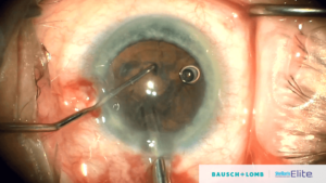 stellaris elite Cataract Surgery