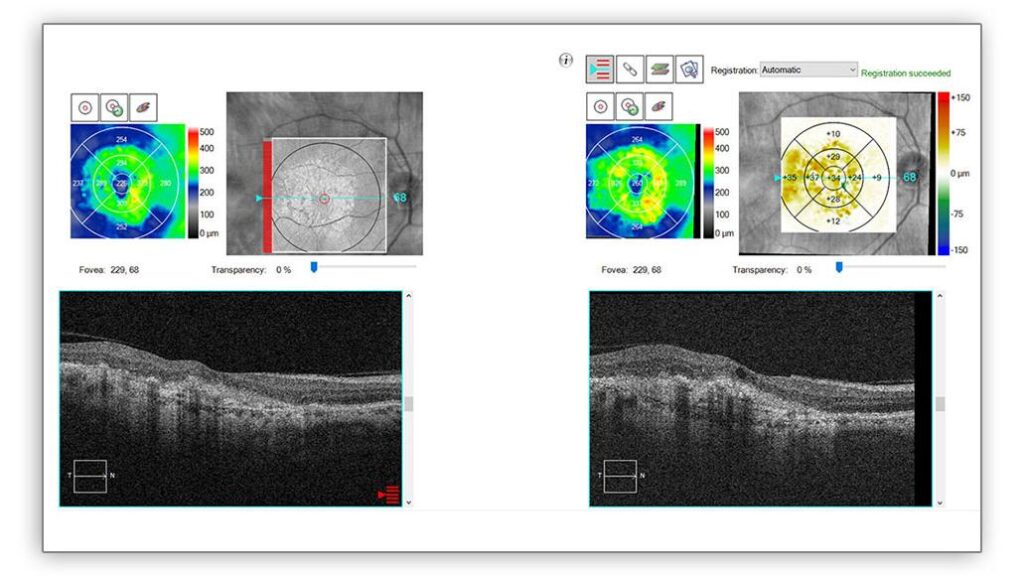 macular-change-analysis-image16_9_2